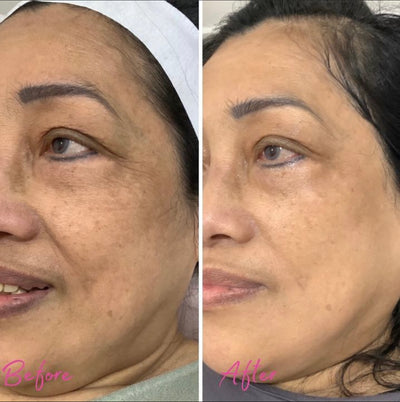 Dermal Pigmentation Removal